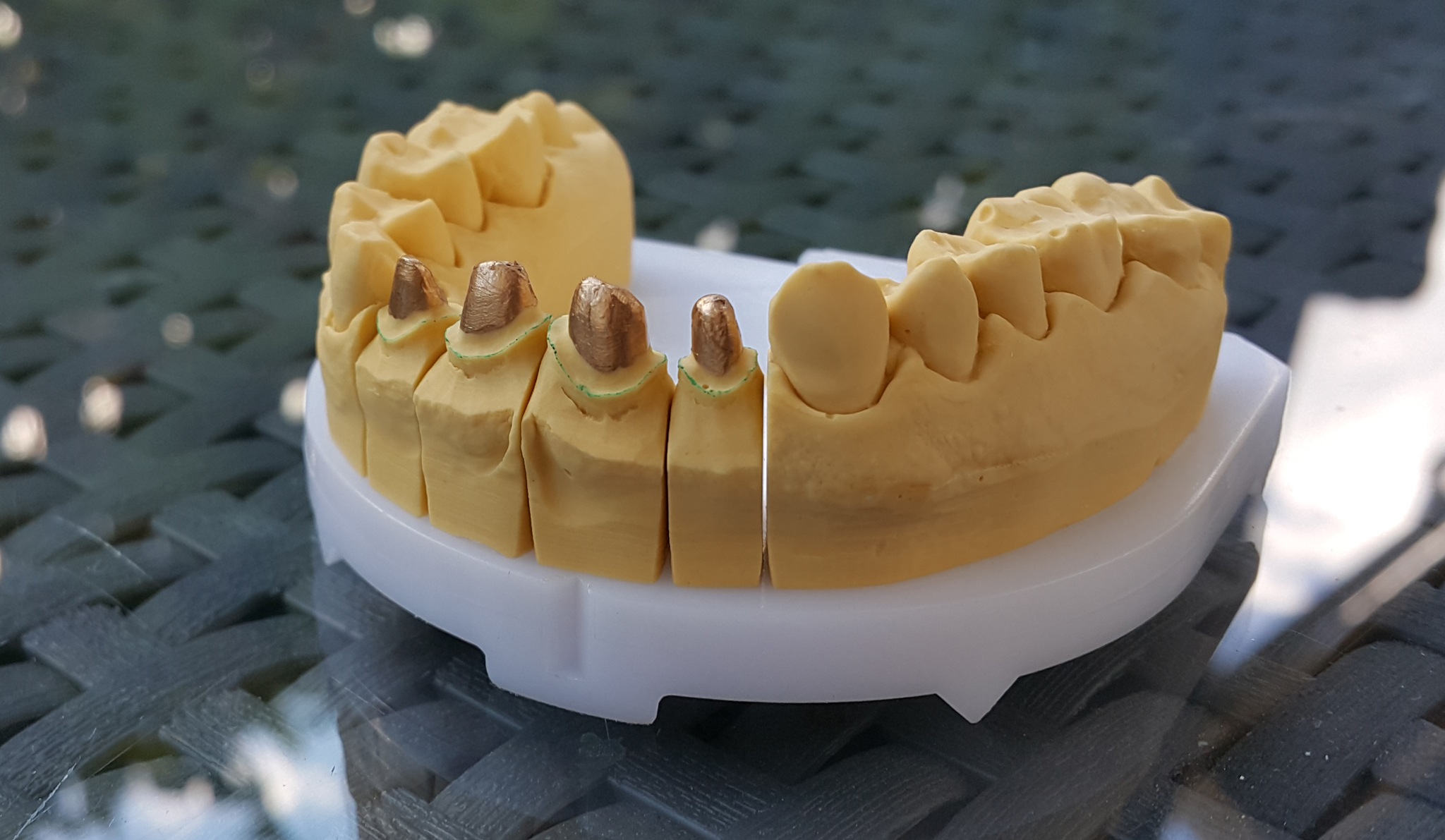 Implantatne nadgradnje